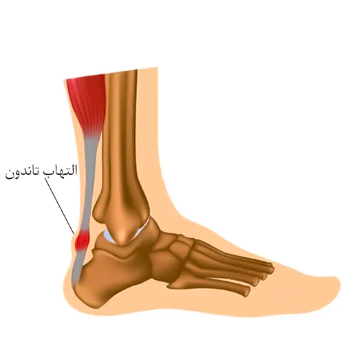 التهاب تاندون از علل بروز پا درد